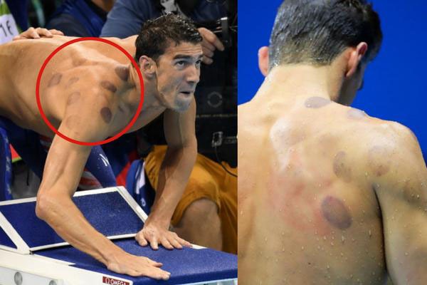 Bańki chińskie - ślady pozostawione na ciele Michaela Phelpsa