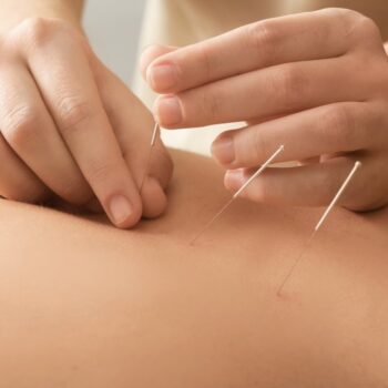 Akupunktura igły do akupunktury