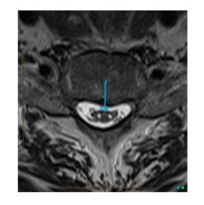 Radiologia - diagnostyka obrazowa kręgosłuopa - oczy węża