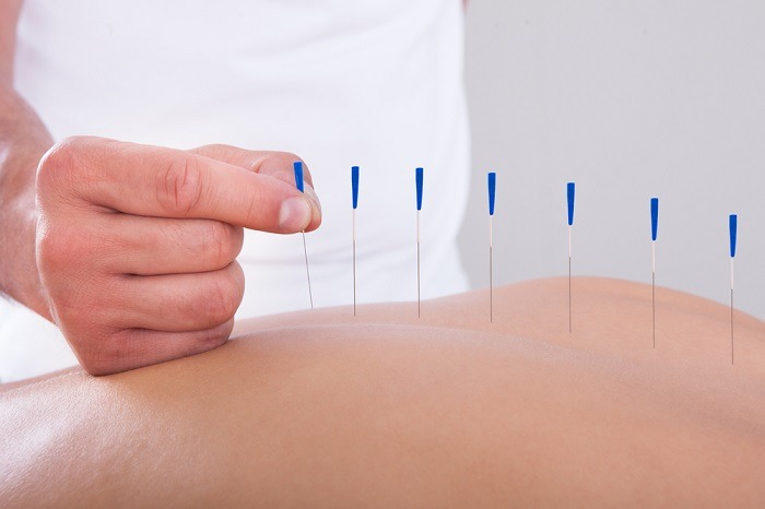 Czy akupunktura boli?
